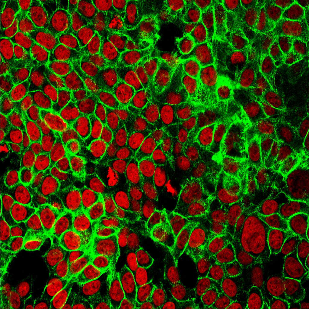 The Dangers Of Skipping A Second Opinion For Cancer Treatment